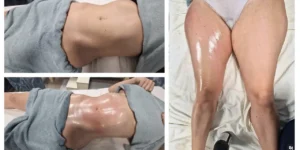 LIMFOMODELIRANJE Tela i Lica